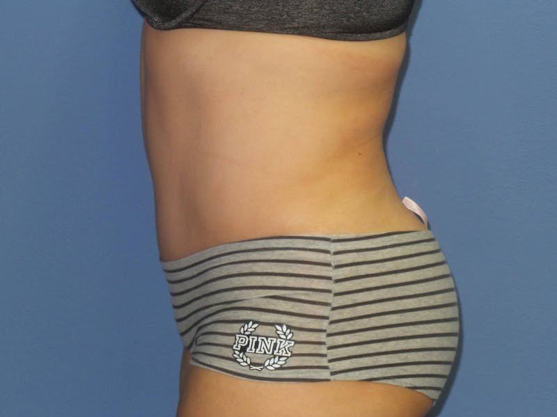 Tummy Tuck Before & After Gallery - Patient 240292 - Image 6