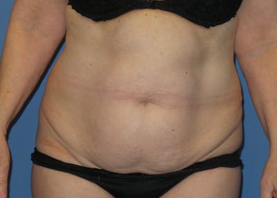 Tummy Tuck Before & After Gallery - Patient 129863 - Image 1