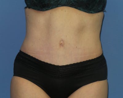 Tummy Tuck Before & After Gallery - Patient 129863 - Image 2