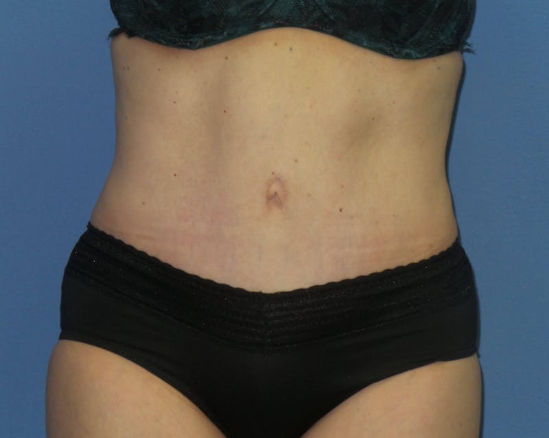 Tummy Tuck Before & After Gallery - Patient 129863 - Image 2