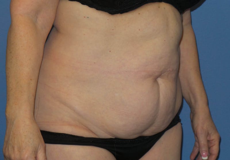 Tummy Tuck Before & After Gallery - Patient 129863 - Image 3
