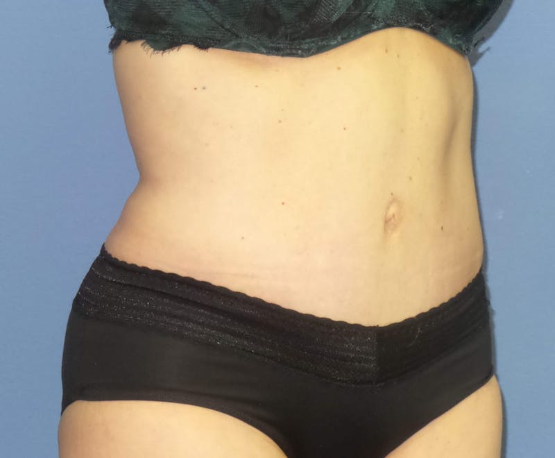 Tummy Tuck Before & After Gallery - Patient 129863 - Image 4
