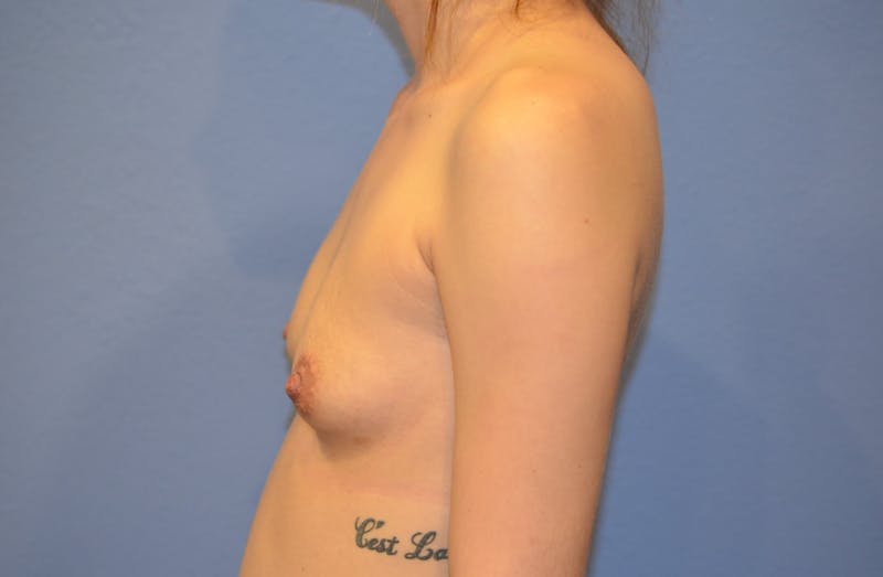 Breast Augmentation Before & After Gallery - Patient 102546 - Image 5