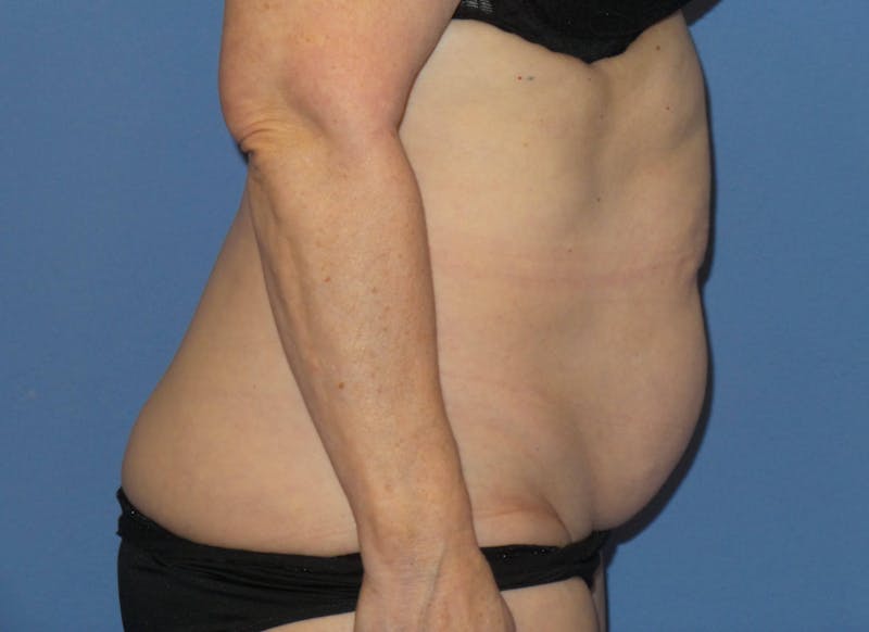 Tummy Tuck Before & After Gallery - Patient 129863 - Image 5