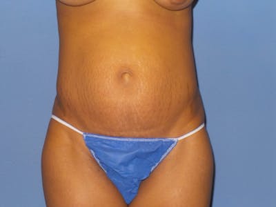 Tummy Tuck Before & After Gallery - Patient 141046 - Image 1