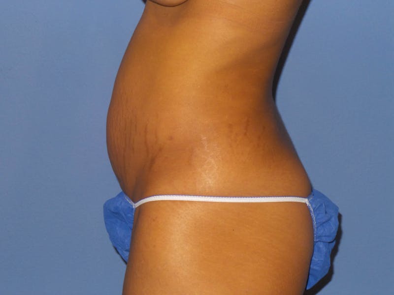 Tummy Tuck Before & After Gallery - Patient 141046 - Image 3