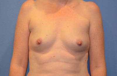 Breast Augmentation Before & After Gallery - Patient 193557 - Image 1