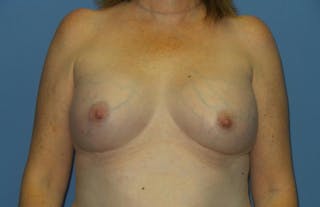 Breast Augmentation Before & After Gallery - Patient 193557 - Image 2