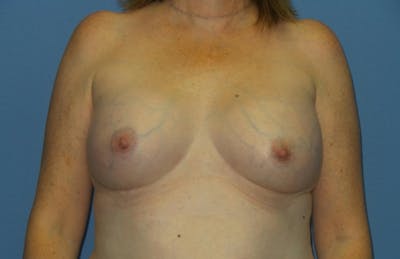 Breast Augmentation Before & After Gallery - Patient 193557 - Image 2