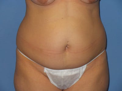 Tummy Tuck Before & After Gallery - Patient 134554 - Image 1