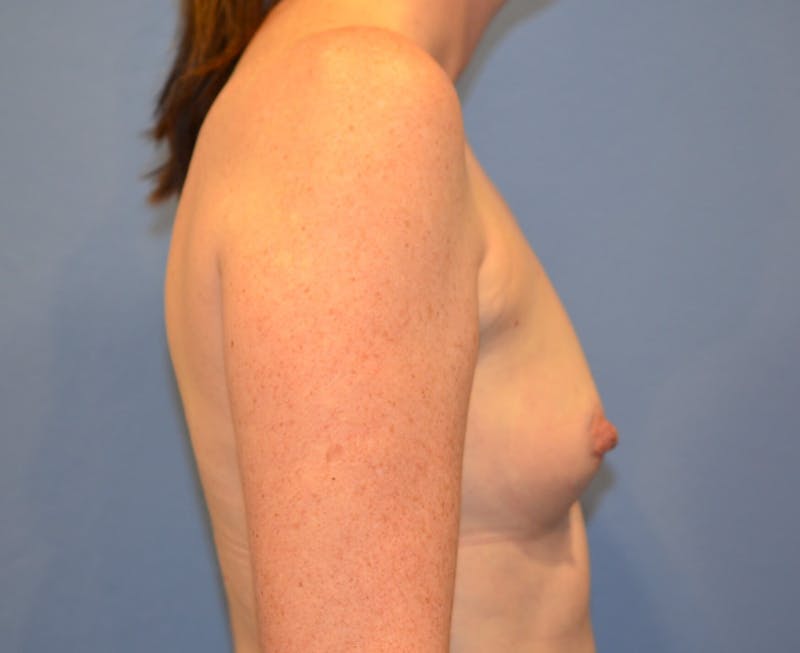 Breast Augmentation Before & After Gallery - Patient 193557 - Image 3