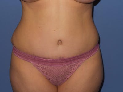Tummy Tuck Before & After Gallery - Patient 134554 - Image 2