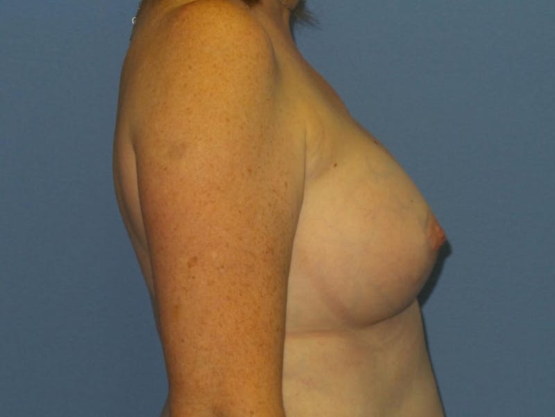 Breast Augmentation Before & After Gallery - Patient 193557 - Image 4