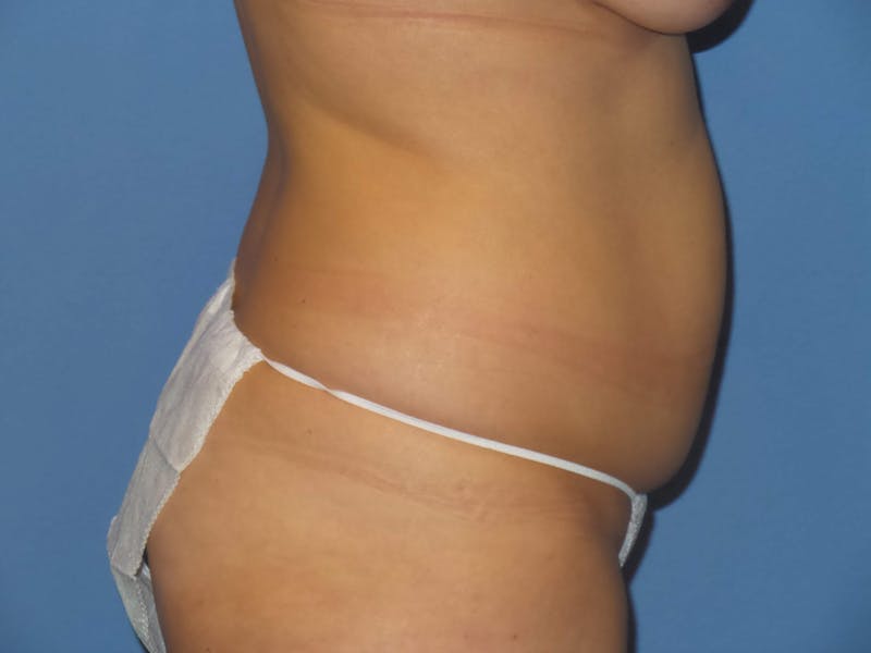Tummy Tuck Before & After Gallery - Patient 134554 - Image 3