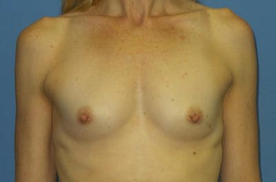 Breast Augmentation Before & After Gallery - Patient 244362 - Image 1