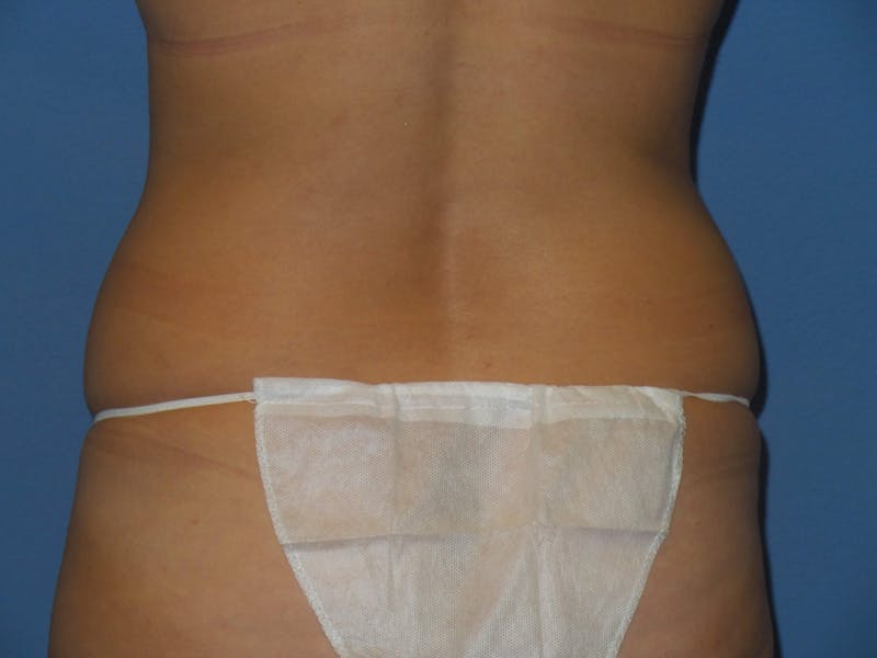 Tummy Tuck Before & After Gallery - Patient 134554 - Image 5