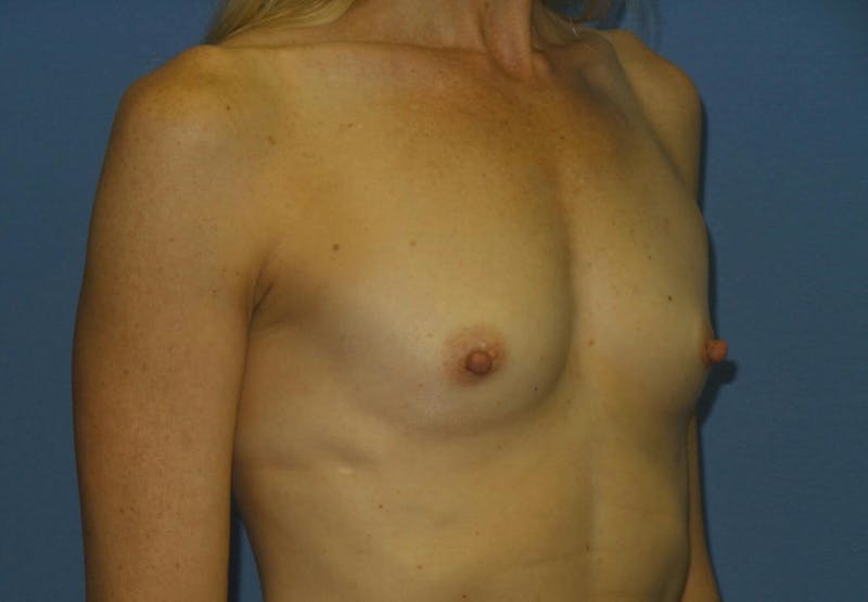 Breast Augmentation Before & After Gallery - Patient 244362 - Image 3