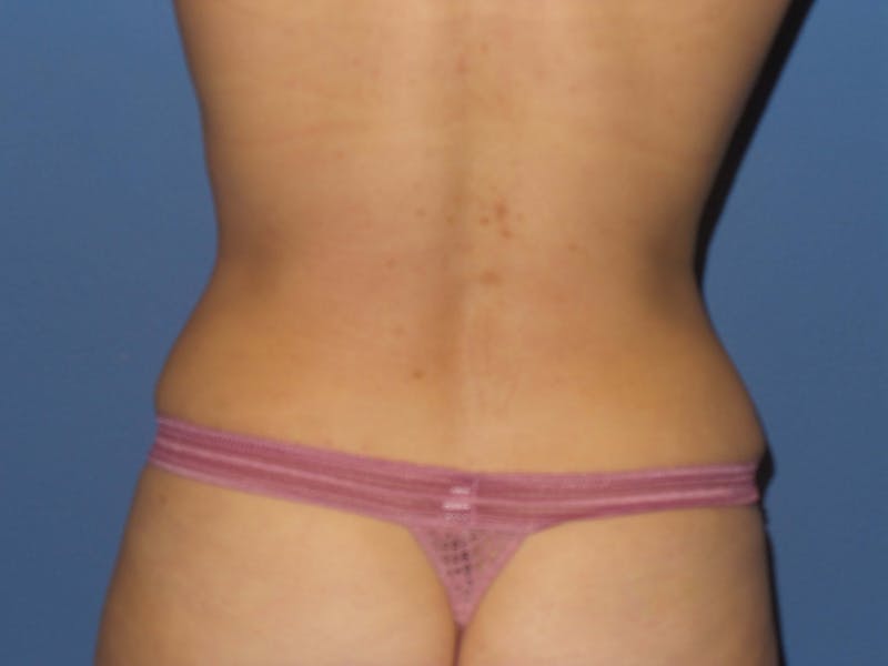 Tummy Tuck Before & After Gallery - Patient 134554 - Image 6