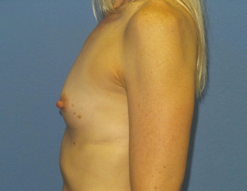Breast Augmentation Before & After Gallery - Patient 244362 - Image 5
