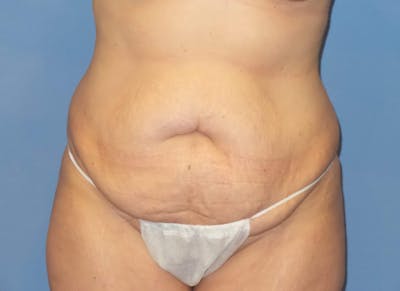 Tummy Tuck Before & After Gallery - Patient 151341 - Image 1