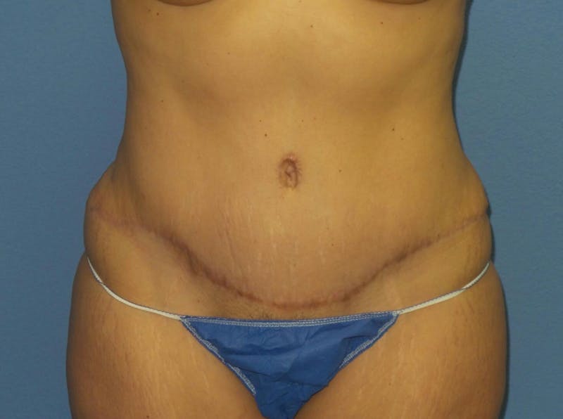 Tummy Tuck Before & After Gallery - Patient 151341 - Image 2