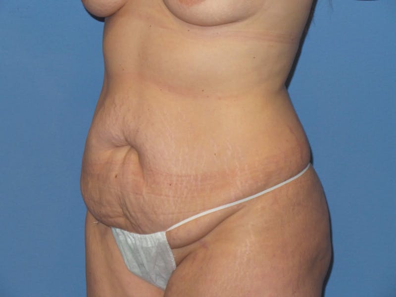 Tummy Tuck Before & After Gallery - Patient 151341 - Image 3