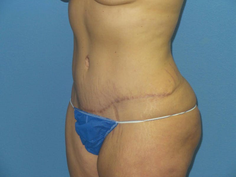 Tummy Tuck Before & After Gallery - Patient 151341 - Image 4
