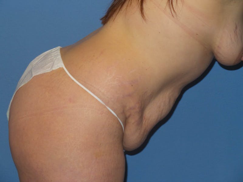 Tummy Tuck Before & After Gallery - Patient 151341 - Image 5