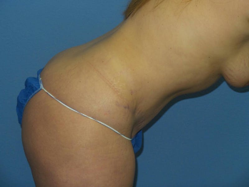 Tummy Tuck Before & After Gallery - Patient 151341 - Image 6