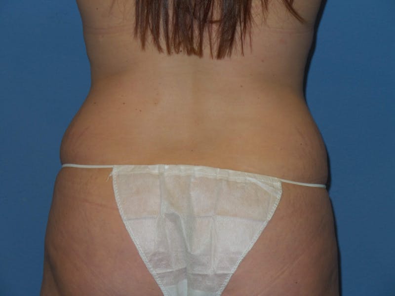Tummy Tuck Before & After Gallery - Patient 151341 - Image 7