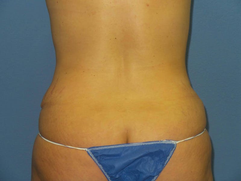 Tummy Tuck Before & After Gallery - Patient 151341 - Image 8
