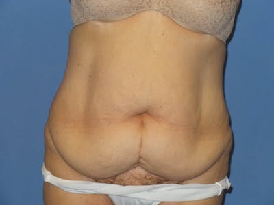 Tummy Tuck Before & After Gallery - Patient 209652 - Image 1