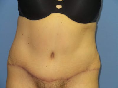Tummy Tuck Before & After Gallery - Patient 209652 - Image 2