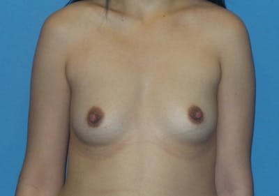 Breast Augmentation Before & After Gallery - Patient 177061 - Image 1