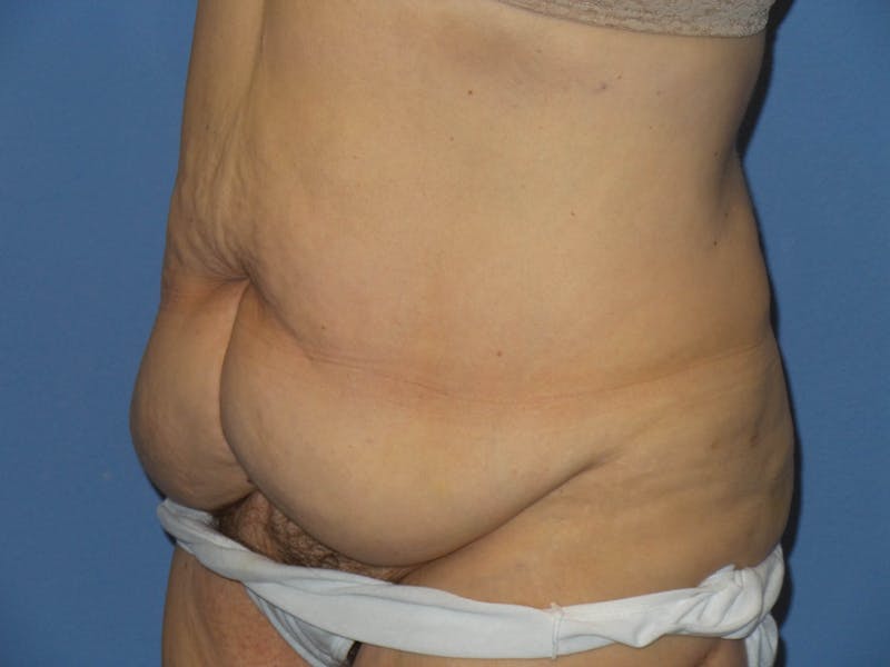 Tummy Tuck Before & After Gallery - Patient 209652 - Image 3