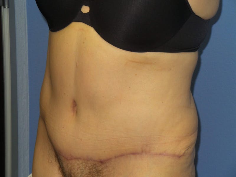 Tummy Tuck Before & After Gallery - Patient 209652 - Image 4