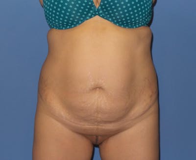 Tummy Tuck Before & After Gallery - Patient 120882 - Image 1