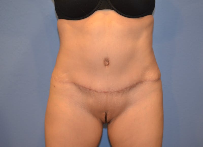 Tummy Tuck Before & After Gallery - Patient 120882 - Image 2