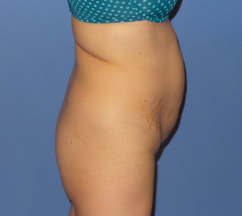 Tummy Tuck Before & After Gallery - Patient 120882 - Image 3