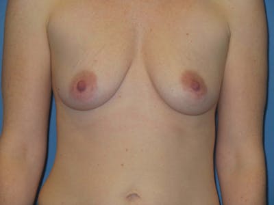 Breast Augmentation Before & After Gallery - Patient 385036 - Image 1