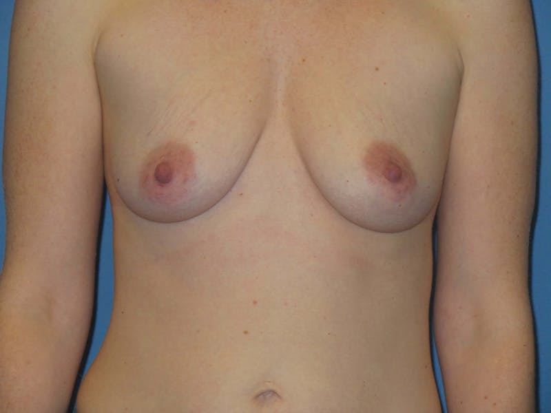 Breast Augmentation Before & After Gallery - Patient 385036 - Image 1