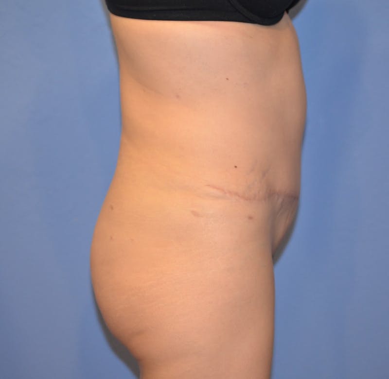 Tummy Tuck Before & After Gallery - Patient 120882 - Image 4
