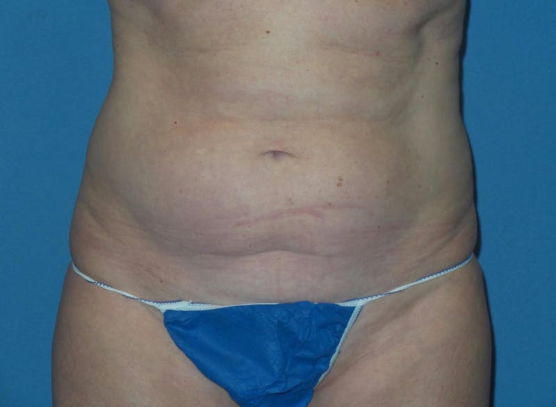 Tummy Tuck Before & After Gallery - Patient 645083 - Image 1