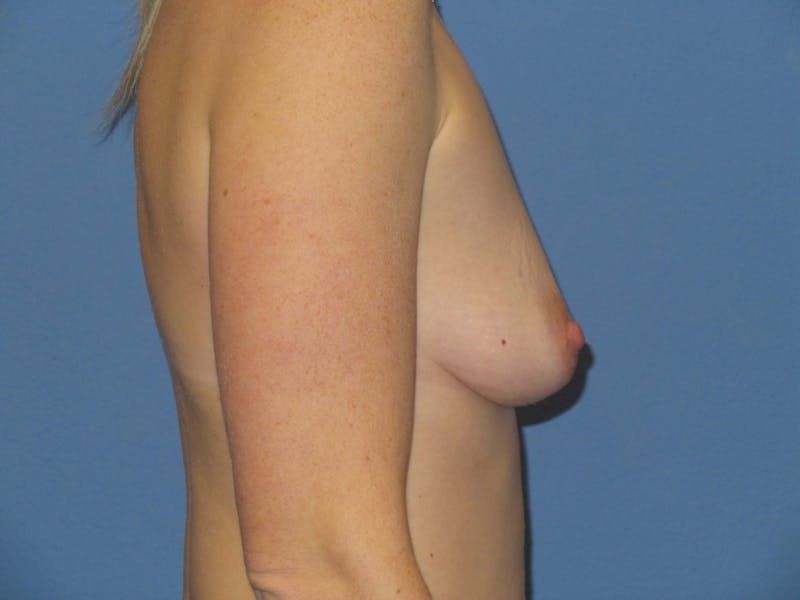 Breast Augmentation Before & After Gallery - Patient 385036 - Image 3