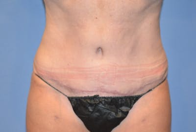 Tummy Tuck Before & After Gallery - Patient 645083 - Image 2