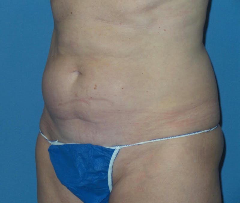 Tummy Tuck Before & After Gallery - Patient 645083 - Image 3
