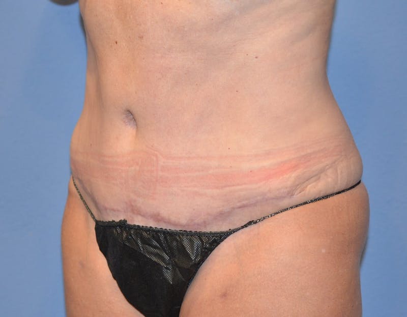 Tummy Tuck Before & After Gallery - Patient 645083 - Image 4