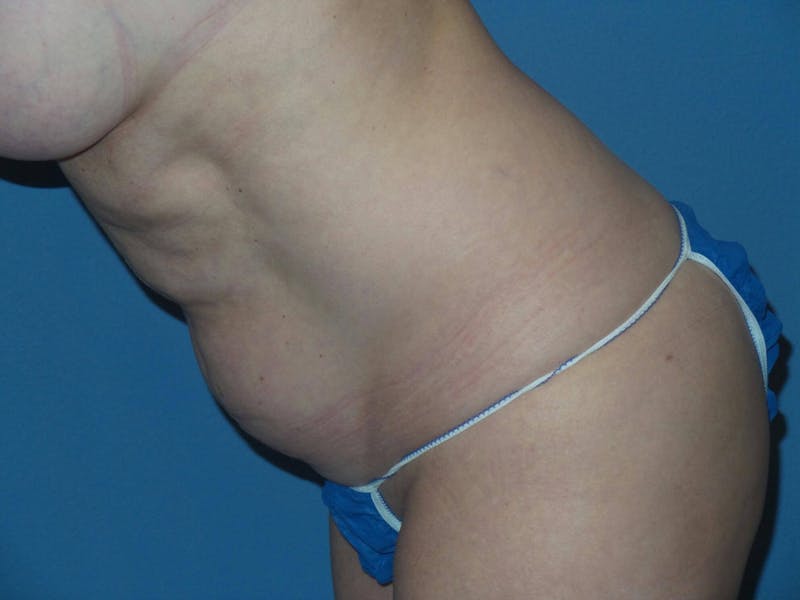 Tummy Tuck Before & After Gallery - Patient 645083 - Image 5