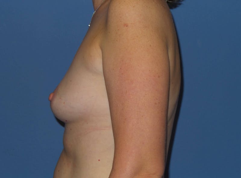 Breast Augmentation Before & After Gallery - Patient 115957 - Image 5