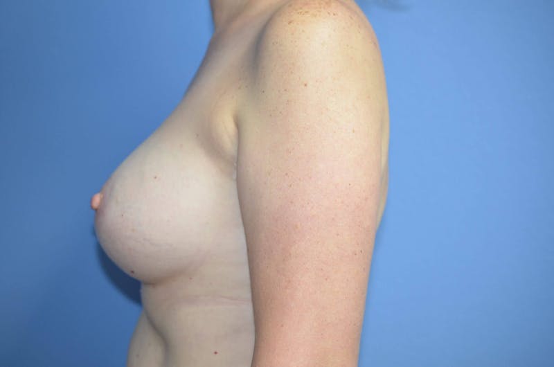 Breast Augmentation Before & After Gallery - Patient 115957 - Image 6